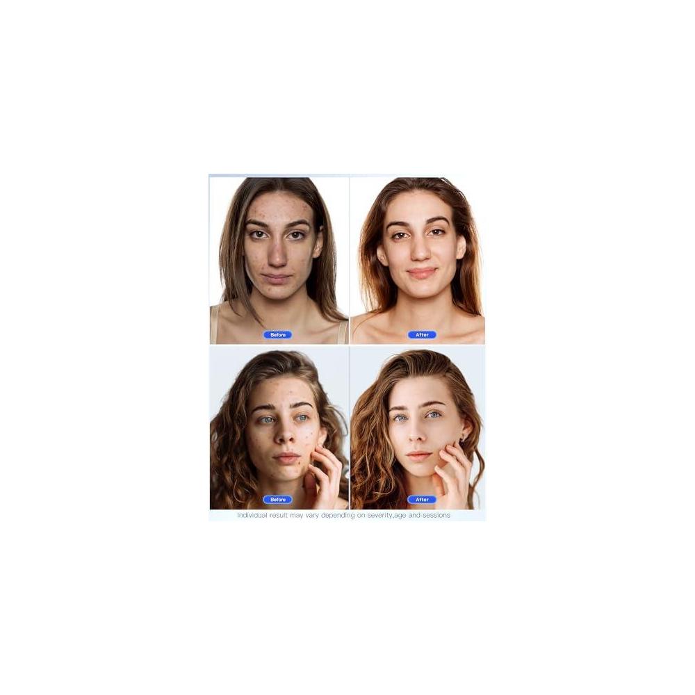 Sistema de terapia de fotones Newkey de luz LED de 7 colores para cuidado facial y máscara de belleza, trata arrugas y acné