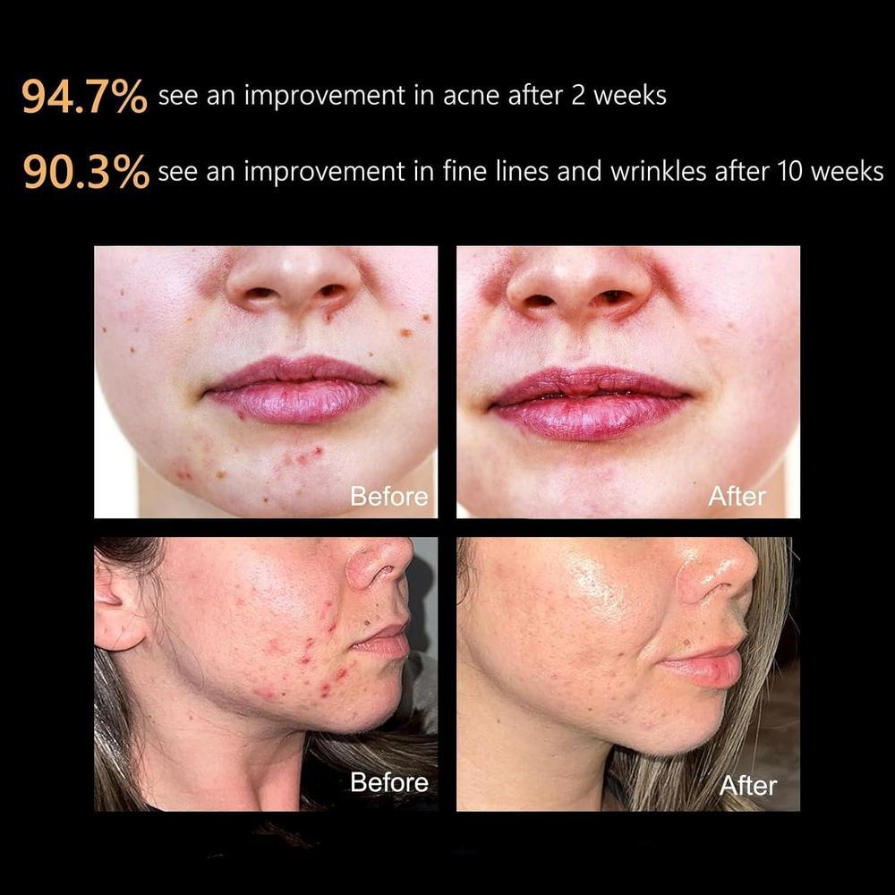 Mascarilla Facial Led Aphrona Aprobada Por Fda Con Fototerapia