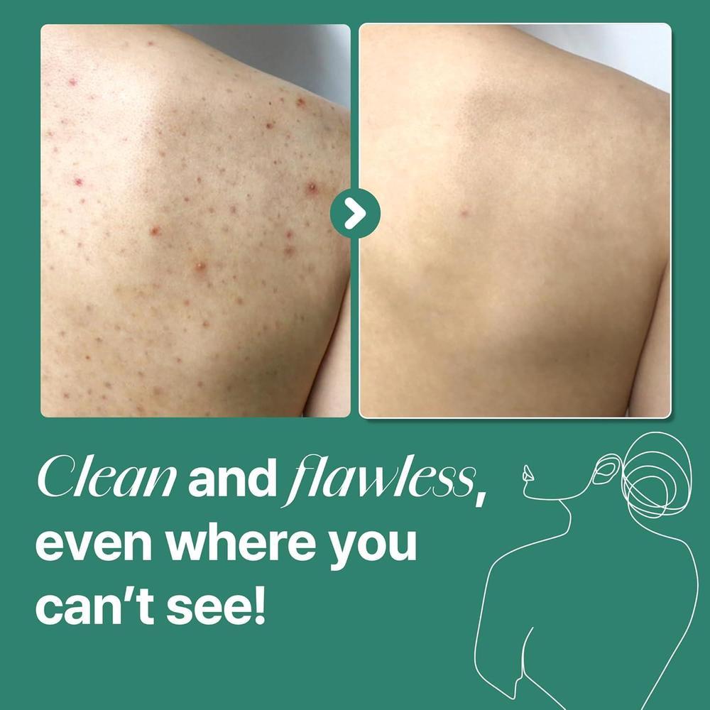 SOME BY MI AHA BHA PHA Miracle Limpiador Antiacné Cuerpo con Árbol de Té y Ácido Salicílico, Limpieza Profunda