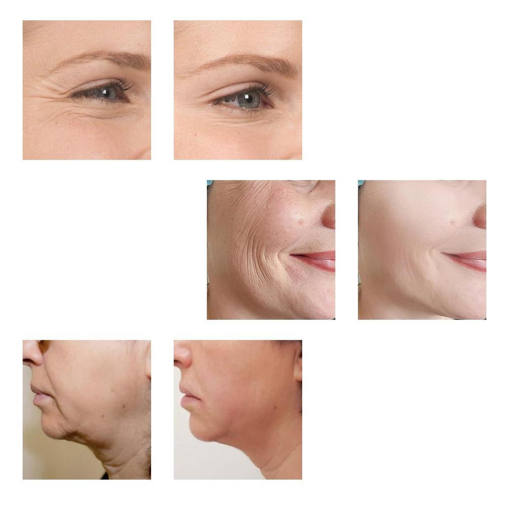 Máquina facial de estiramiento mediante radiofrecuencia, masajeador antienvejecimiento y dispositivo deshinchador ocular