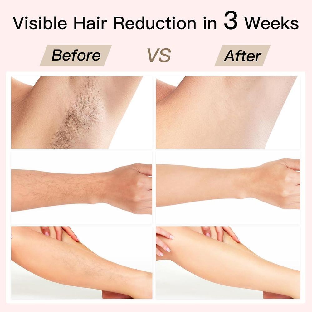Depilación IPL Bosidin Con Enfriamiento De Hielo Y Rejuvenecimiento Facial SR